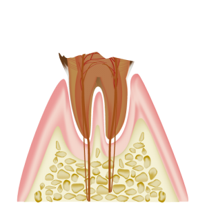 を用いて歯髄を保存する処置を行う場合もあります。 C4　歯質が失われたむし歯