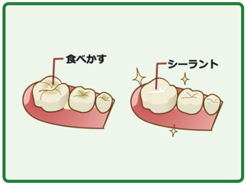 シーラント