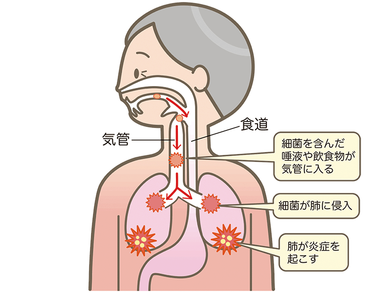 肺炎