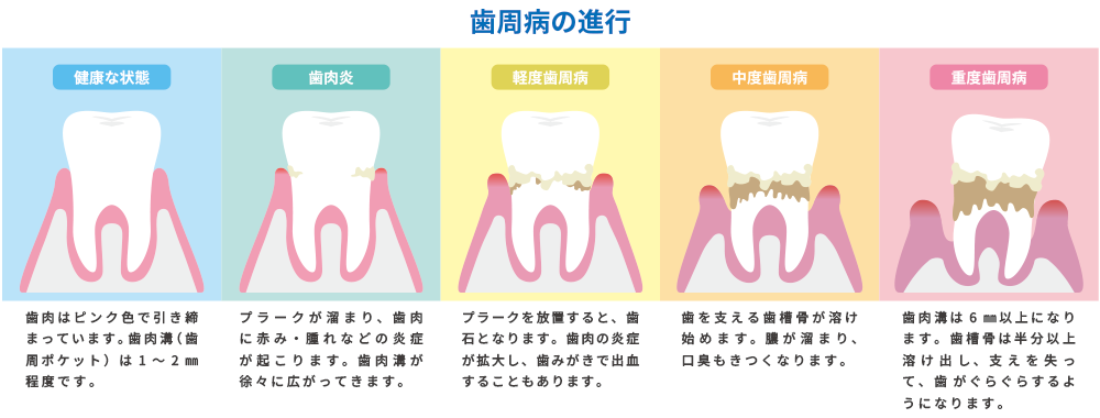 歯周病の進行