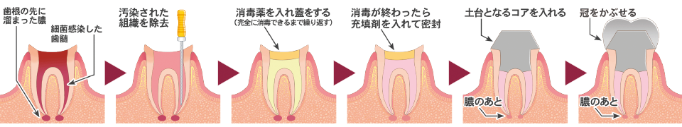 根管治療